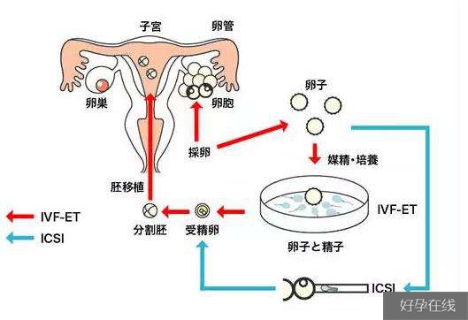 什么是体外受精