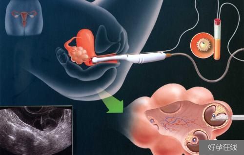试管取卵过程