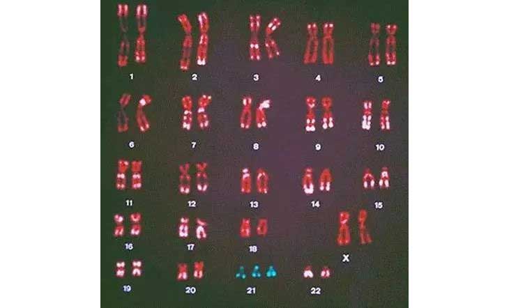 唐氏筛查-染色体构造提示