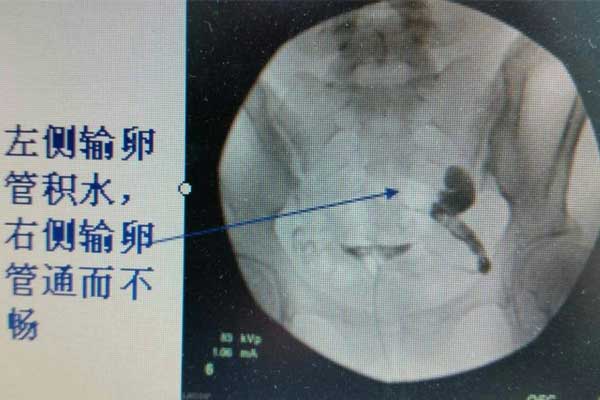 输卵管检查报告样本