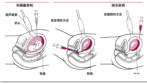 绒毛穿刺流程图