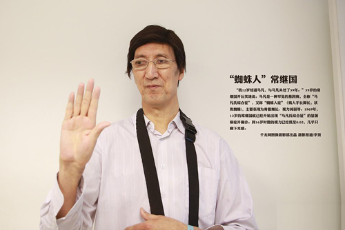 马凡氏综合症病人面相