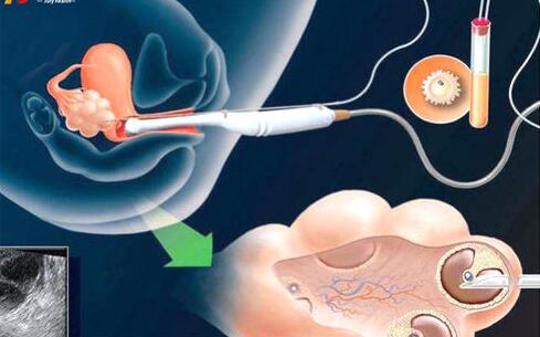 泰国做试管婴儿如何安全取卵?精液少会影响试管婴儿吗